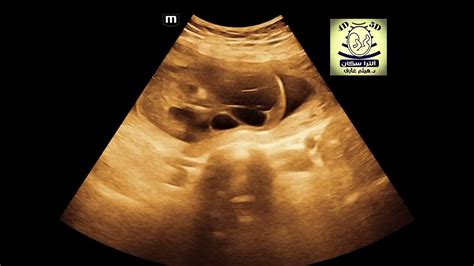 Cystic Hygroma With Hydrops Fetalis Fetal Ultrasound Youtube