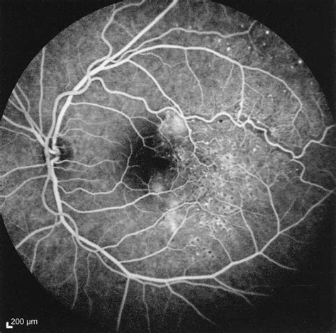 Post-treatment OCT reveals reduction in macular edema. Figure 8 ...