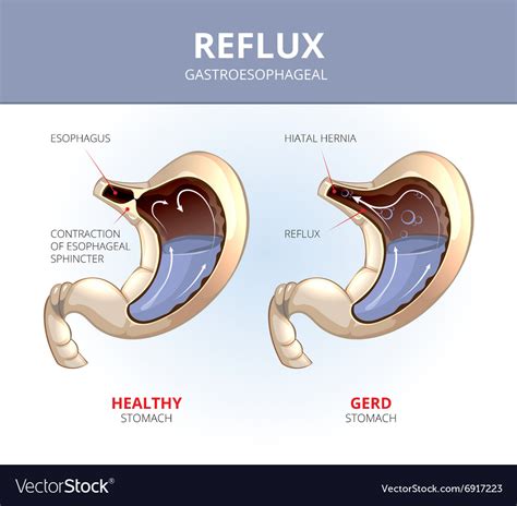 Gastroesophageal Reflux Disease Healthy And Sick Vector Image