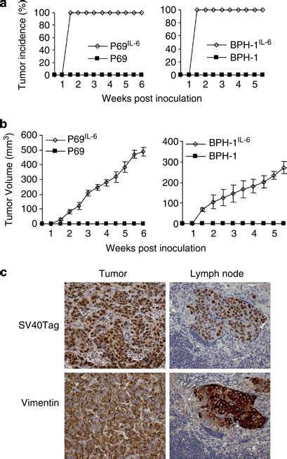 Il 6 Promotes Progressive Tumorigenesis And Metastatic Progression Of