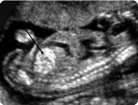 Ultrasound Prediction Of Symptomatic Congenital Cytomegalovirus