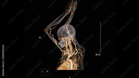 Cta Brachial Artery Or Ct Scan Of Upper Extremity 3d Rendering Image