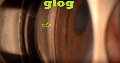 Glaucoma Specialist Blog The Glog