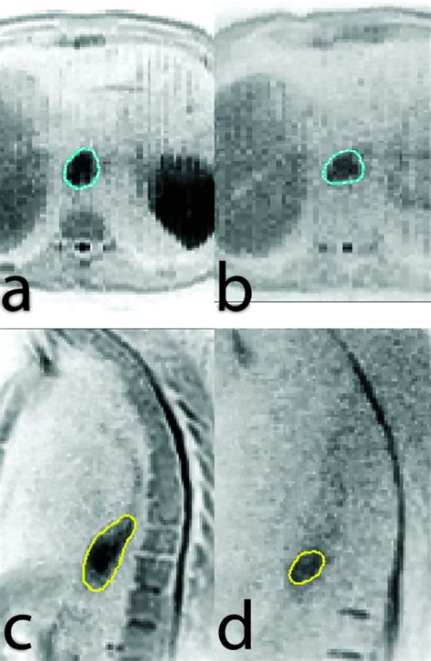 Review Of MR Guided Radiotherapy For Esophageal Cancer Abstract