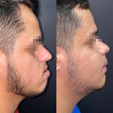 Cirurgia ortognática Antes e depois e Informações sobre