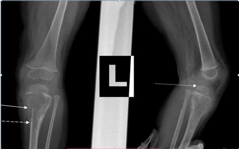 Left Knee X Ray Ap And Lateral View Lytic Permeative Lesion Of The Download Scientific