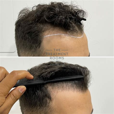 Hair Transplant 1552 Grafts Treatment Rooms London