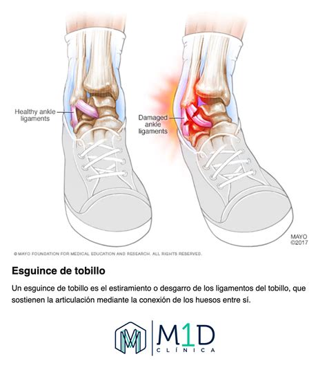 Las 7 Lesiones De Tobillo Y Pie Mas Comunes Causas Sintomas Y Images