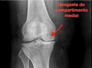 Desgaste Do Joelho Porque Ele Ocorre Diagn Stico E Tratamento