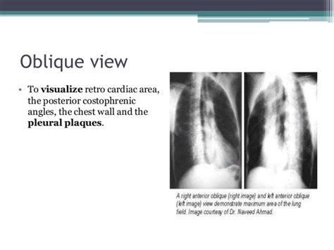 Chest x ray positioning