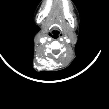 Arteriovenous malformation of the neck | Radiology Case | Radiopaedia.org