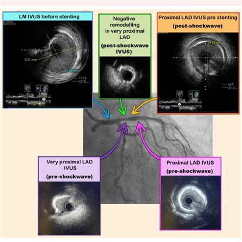 Intravascular Ultrasound Ivus Measurements In Left Main And Proximal Download Scientific