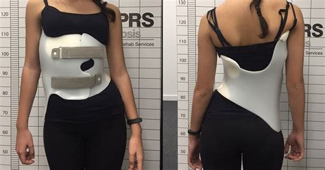 Scoliosis Brace