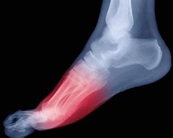 Metatarsalgia (Ball of Foot Pain): Causes and Treatment Options