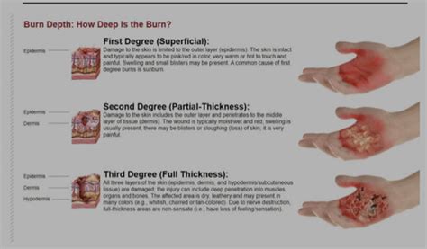 Explain The Difference Between 1st 2nd And 3rd Degree Burns