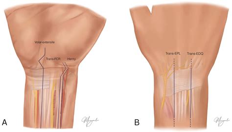 Surgical Exposures Of The Distal Radius For Fracture Fixation Published In Surgicoll