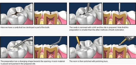 COMPOSITE FILLING DocDentalSmile