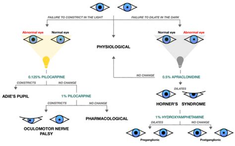 Anisocoria Geeky Medics