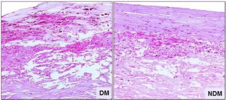 Human Diabetic Atherosclerotic Plaques Are Associated With Increased