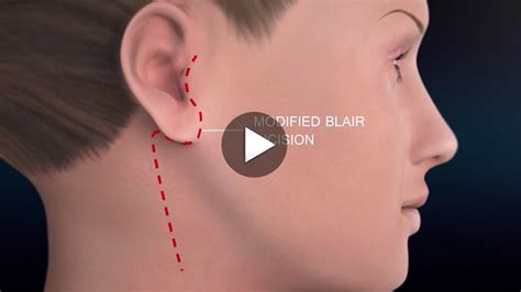 Parotid Surgery Animation | Overview of Minimally Invasive Parotidectomy | Salivary gland ...