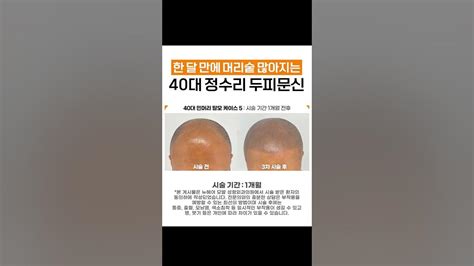 40대 정수리 탈모 두피문신 한 달 만에 머리숱 많아 보이는 역대급 가성비 시술 Youtube