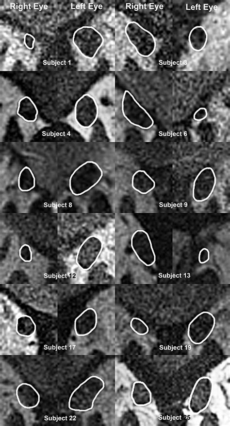 Superior Oblique Extraocular Muscle Shape In Superior Oblique Palsy