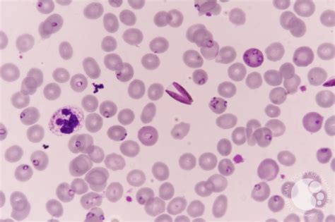 Falciparum-Gametocytes and Ring stages