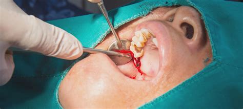 Recovery Tips And Timeline What To Expect After Wisdom Tooth Removal