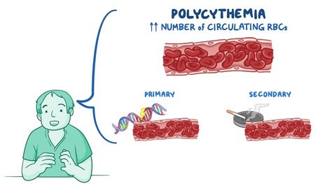 Polycythemia: Nursing - Osmosis Video Library