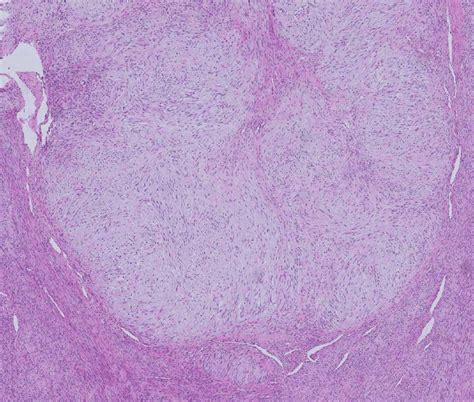 Histopathology And Immunohistochemistry Findings The Tumor Shows