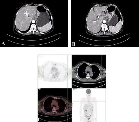 Frontiers Rare Metastasis Of Gastric Cancer To The Axillary Lymph Node A Case Report