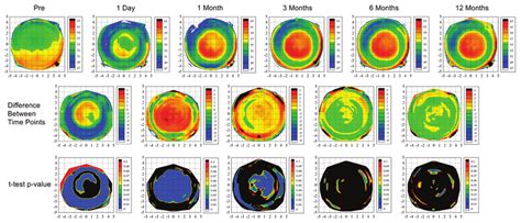 Longitudinal Changes In Epithelial Thickness After Myopic Laser In Situ