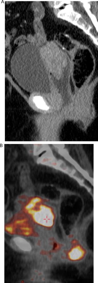 72years Old Female Patient With History Of Cancer Colon Underwent