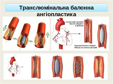 ІХС. Стенокардія. Інфаркт міокарда. | Презентація. внутрішня медицина