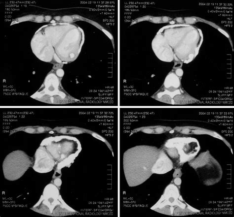 Constrictive Pericarditis From A Severely Calcified Pericardium