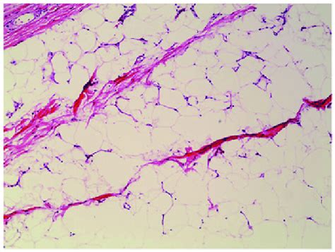 Histopathological Examination Of The Resected Specimen Revealing A Mass