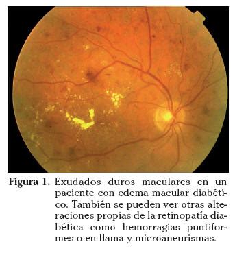 Edema macular diabético Asociación Mácula Retina