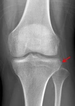 The Relationship Between A Segond Fracture And Meniscus Injury In