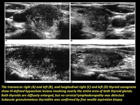 Presentation1 Pptx Radiological Imaging Of The Thyroid Gland Disease