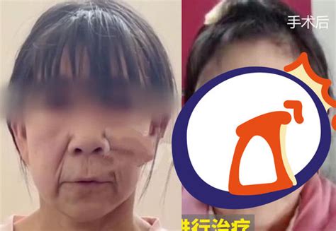 14歲少女比母親還顯老！像70歲嬤「整形2次重生」：手術非常滿意 Ettoday大陸新聞 Ettoday新聞雲