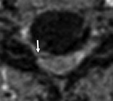 Accuracy Of Contrast Enhanced Mdct And Mri For Identifying The Severity