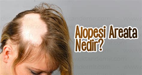 Alopesi Areata Nedir Dermatolog Dr Ektan Demir