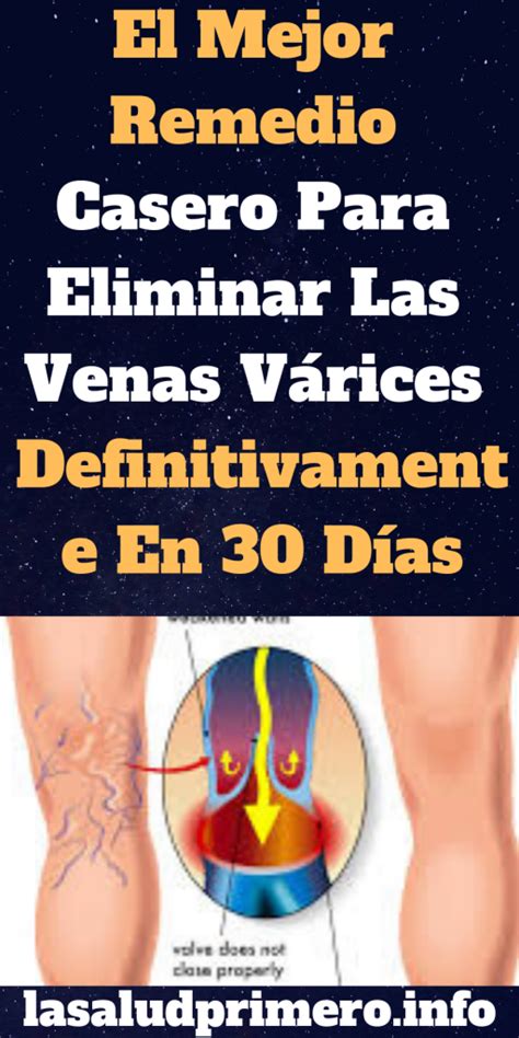 El Mejor Remedio Casero Para Eliminar Las Venas Várices Definitivamente