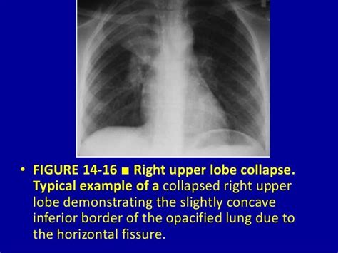 Pulmonary Lobar Collapsevessential Considerations 14 Dr Muhammad Bi