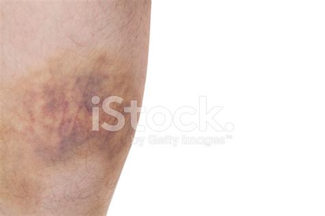 Bad Bruise Stock Photo | Royalty-Free | FreeImages