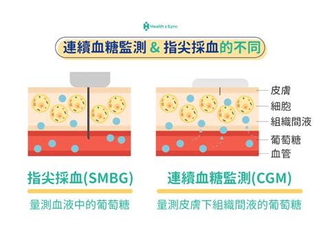 連續血糖監測 Cgm 準嗎？cgm 出現誤差的三個原因 Health2sync Blog