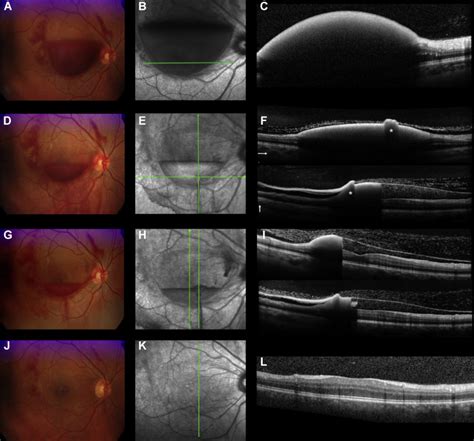 Multimodal Imaging Of Subhyaloid Hemorrhage In Valsalva Retinopathy