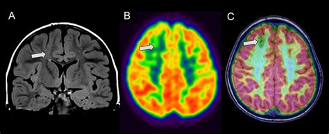 A Year Old Girl With Bottom Of Sulcus Focal Cortical Dysplasia Type