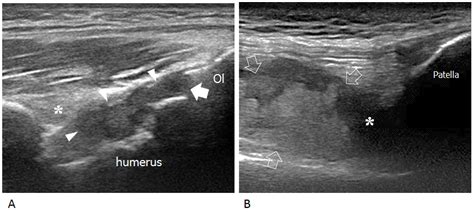 Jcm Free Full Text Ultrasound For Early Detection Of Joint Disease