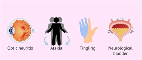 Symptoms of multiple sclerosis